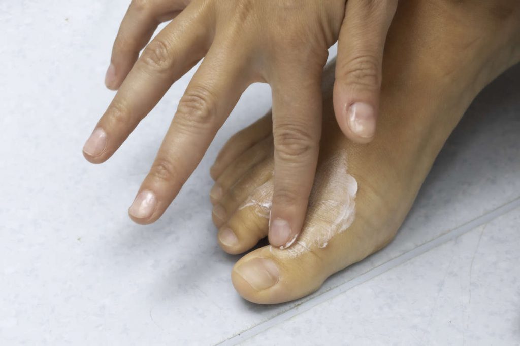 Mycose des pieds : reconnaître les signes et savoir quand consulter – MDHP