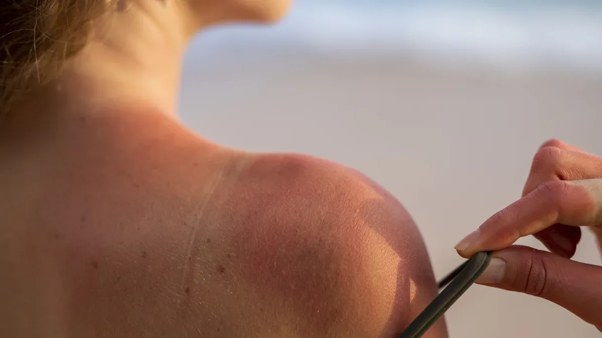 Détails de la peau des coups de soleil d'une femme du soleil de la plage
