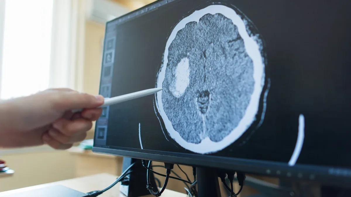 La main d'un médecin pointe avec un stylo un écran d'ordinateur affichant un scanner cérébral avec une grosse tumeur ou une lésion d'AVC lors d'un diagnostic médical clinique dans un bureau d'hôpital